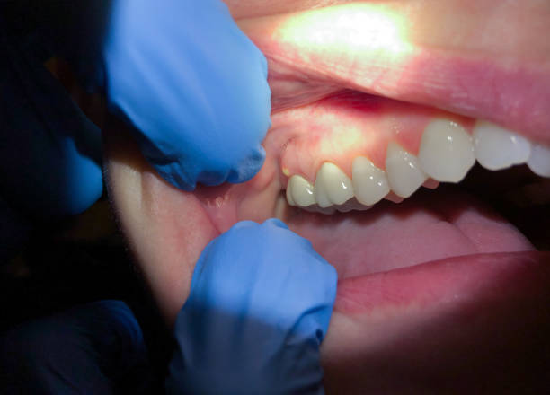 Best Emergency Denture Repair in Holtsville, NY