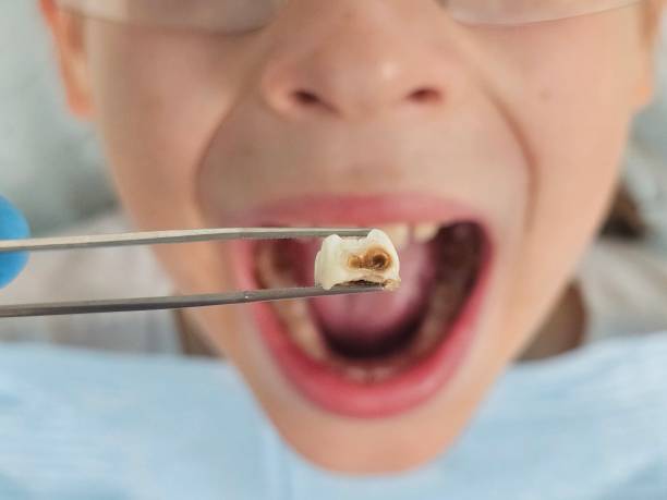 Best Emergency Dental Care for Broken or Chipped Teeth in Holtsville, NY